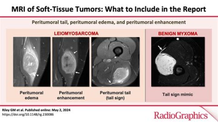Are all soft tissue masses cancerous?
