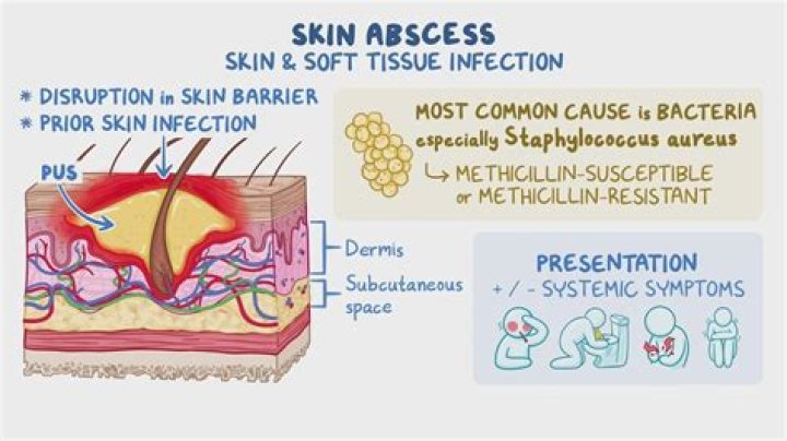 Are boils and abscess the same thing?