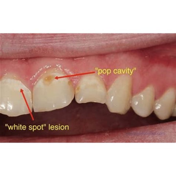 Are cavities always holes?