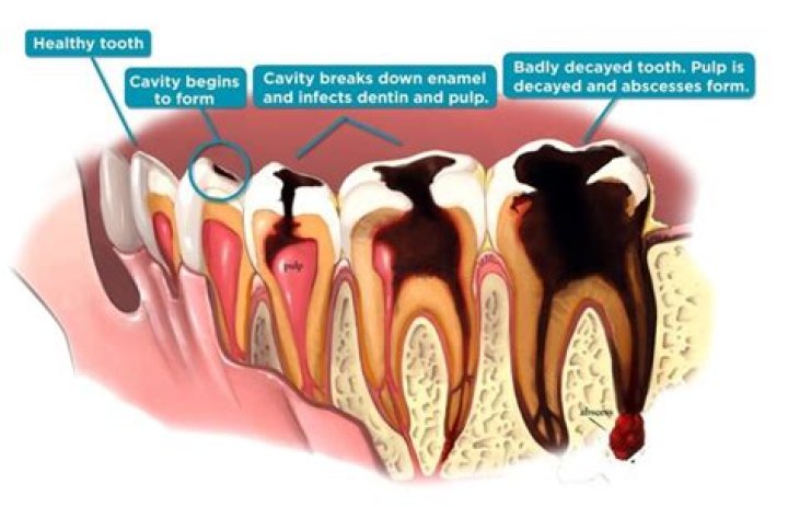 Are my teeth decaying?