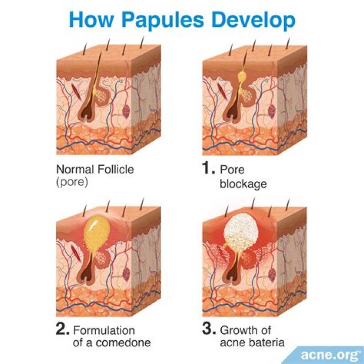Are papules permanent?