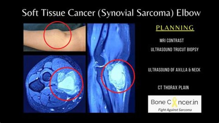 Are sarcomas smooth?