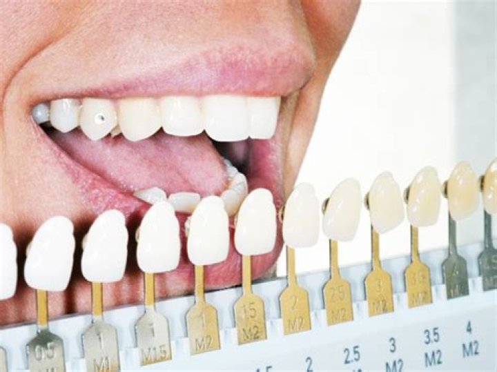 Are teeth stains permanent?