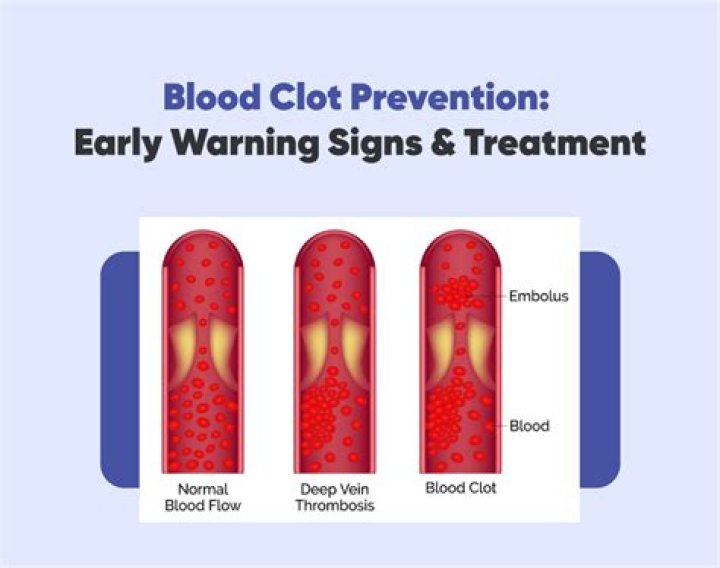 Are there any warning signs of a blood clot?