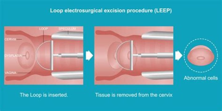 Are you awake for LEEP procedure?
