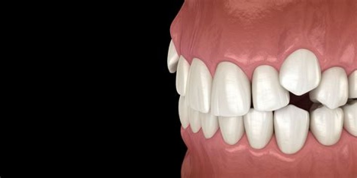 Can a canine tooth be removed?