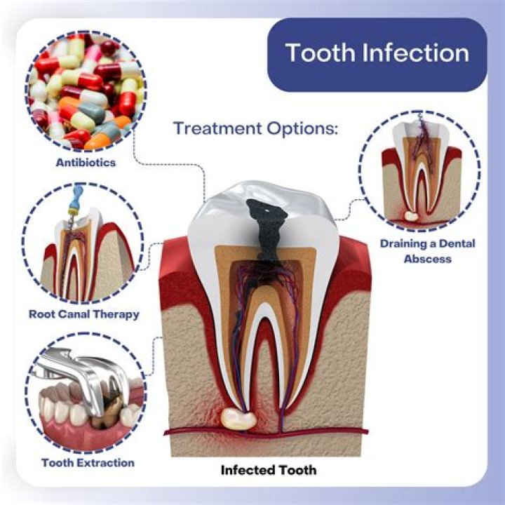 Can a dentist miss a tooth infection?