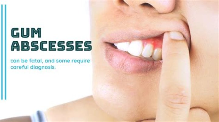 Can a gum abscess burst on its own?