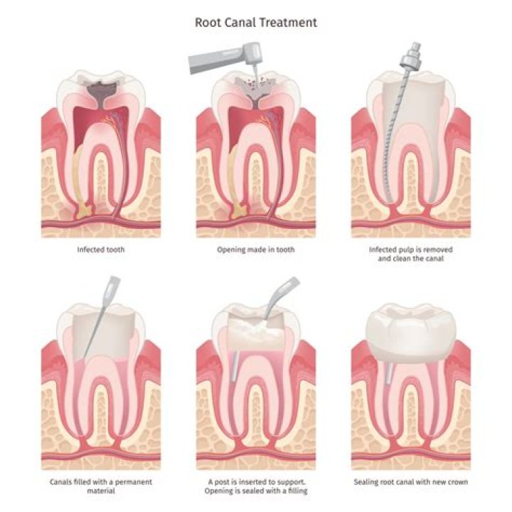 Can a root canal last a lifetime?