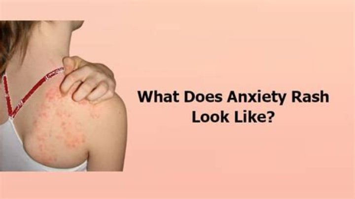 Can anxiety cause rashes?