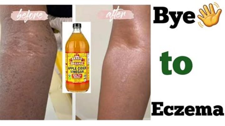 Can apple cider vinegar clear eczema?