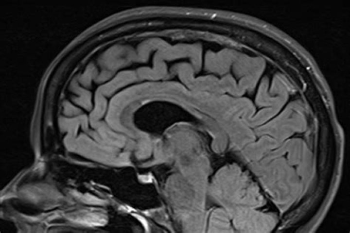 Can brain tumors be seen on MRI without contrast?