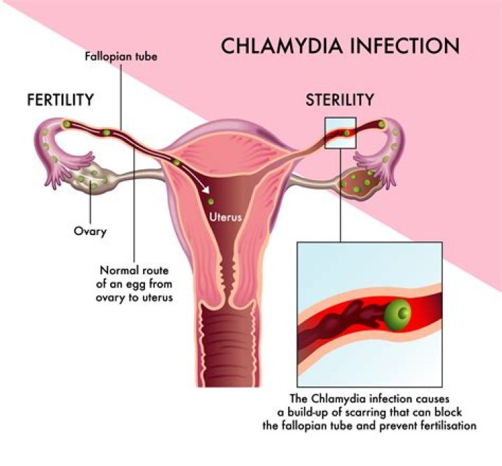 Can chlamydia be cured after 2 years?
