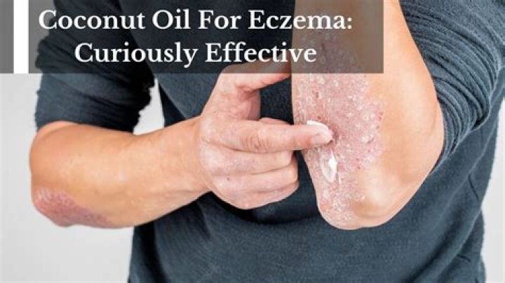 Can coconut oil cure eczema?