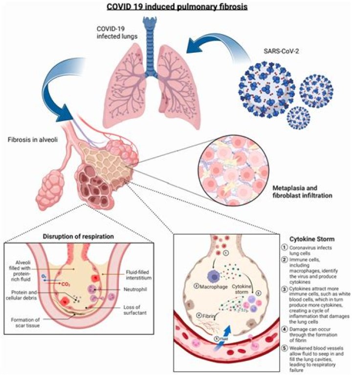Can Covid cause MS relapse?
