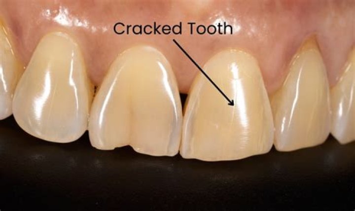 Can cracked teeth heal?