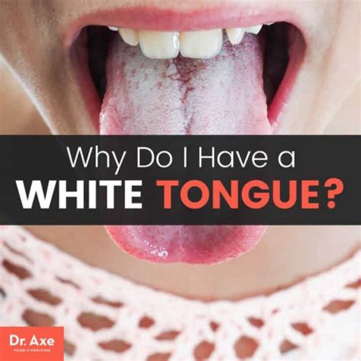Can dehydration cause white tongue?