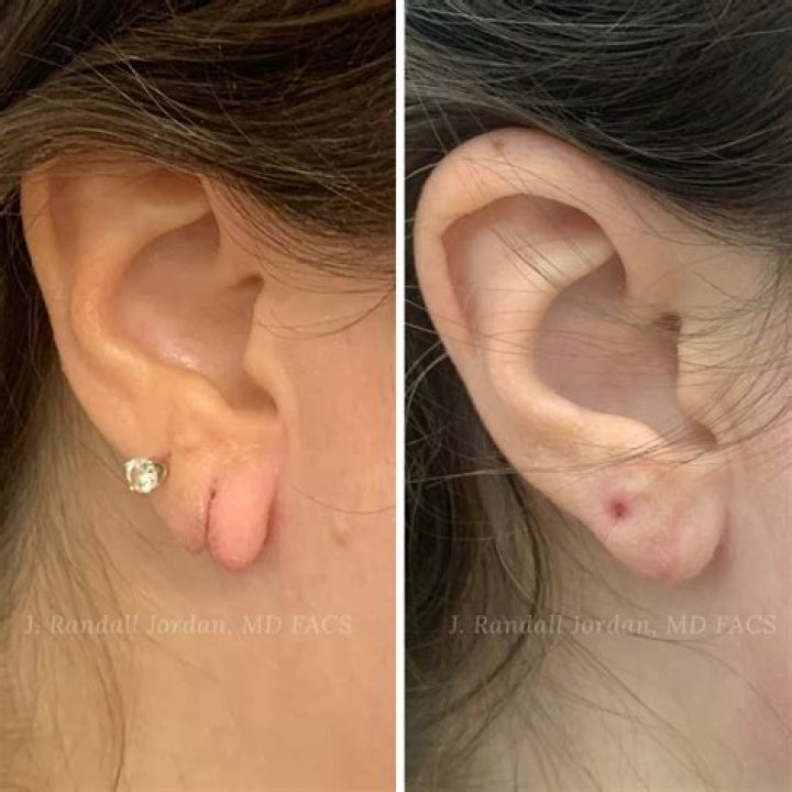 Can earring holes close after years?