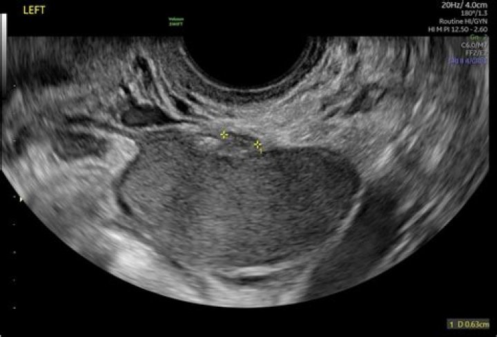 Can endometritis be seen on ultrasound?