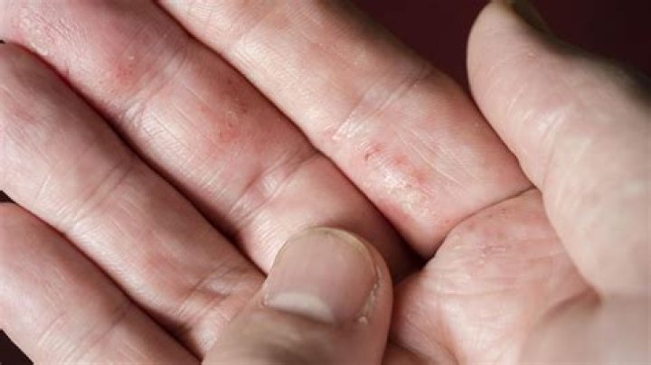 Can Epstein-Barr cause arthritis?