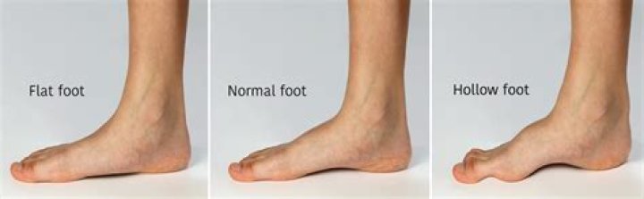 Can flat feet get worse?
