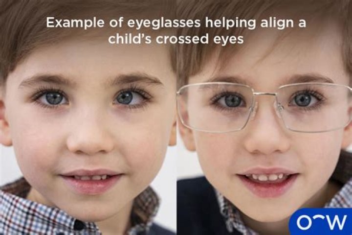 Can glasses cause strabismus?
