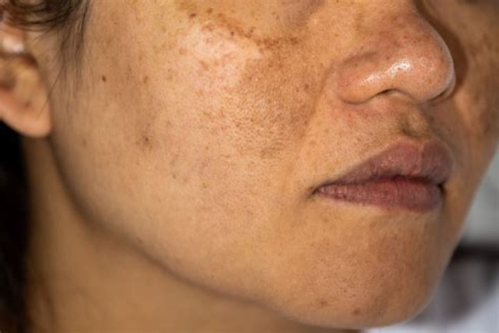 Can hyperpigmentation be cured?