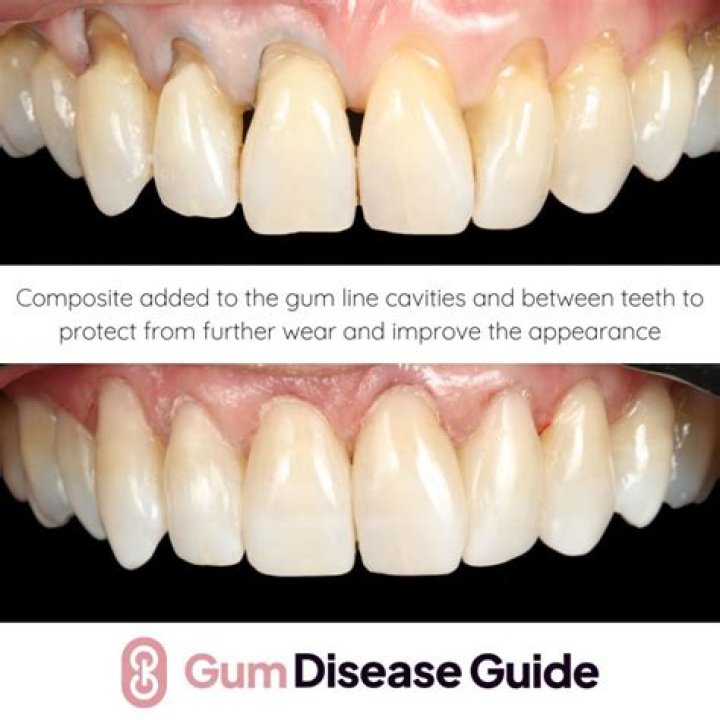 Can I drive home after gum graft?