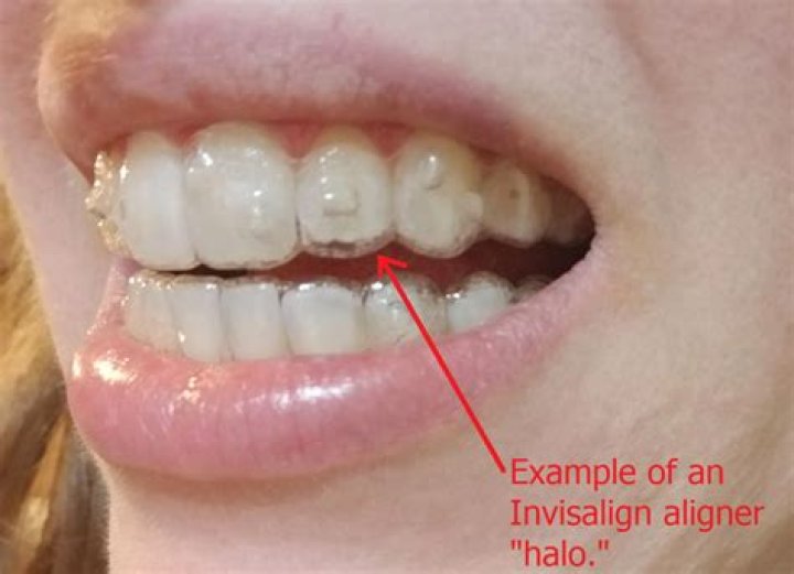 Can I eat a banana with Invisalign?