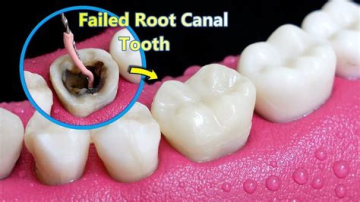 Can I get a refund for failed root canal?