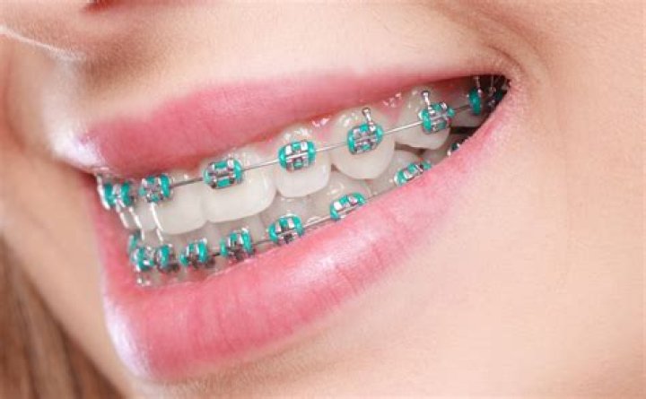 Can I get braces for free?