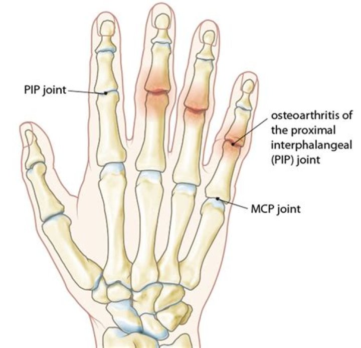 Can I get PIP for arthritis?