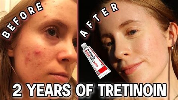 Can I use tretinoin on my legs?