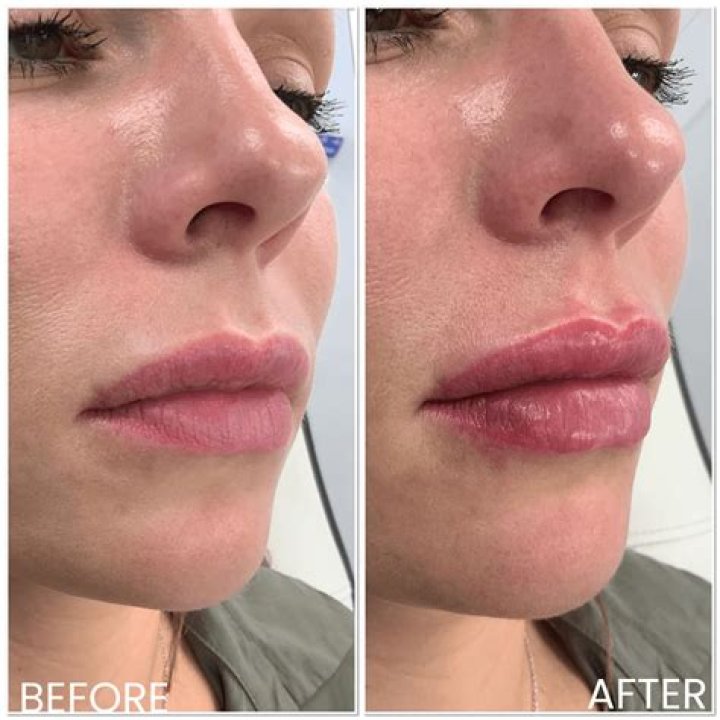 Can I vape before lip fillers?