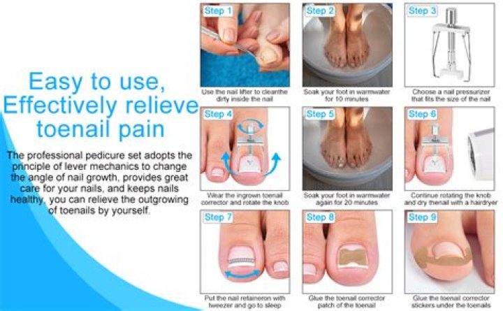 Can I wear shoes after toenail removal?
