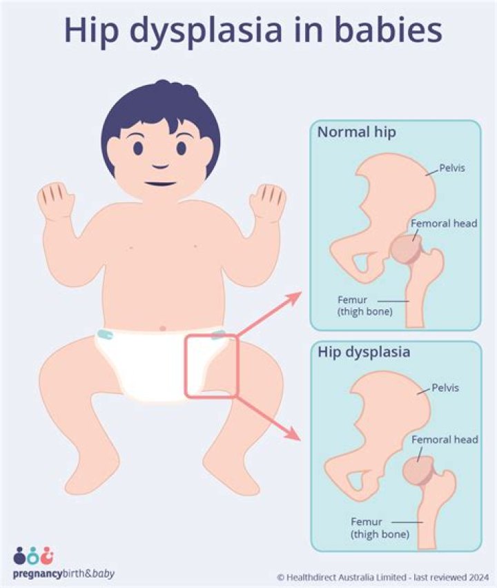 Can Jumperoos cause hip dysplasia?