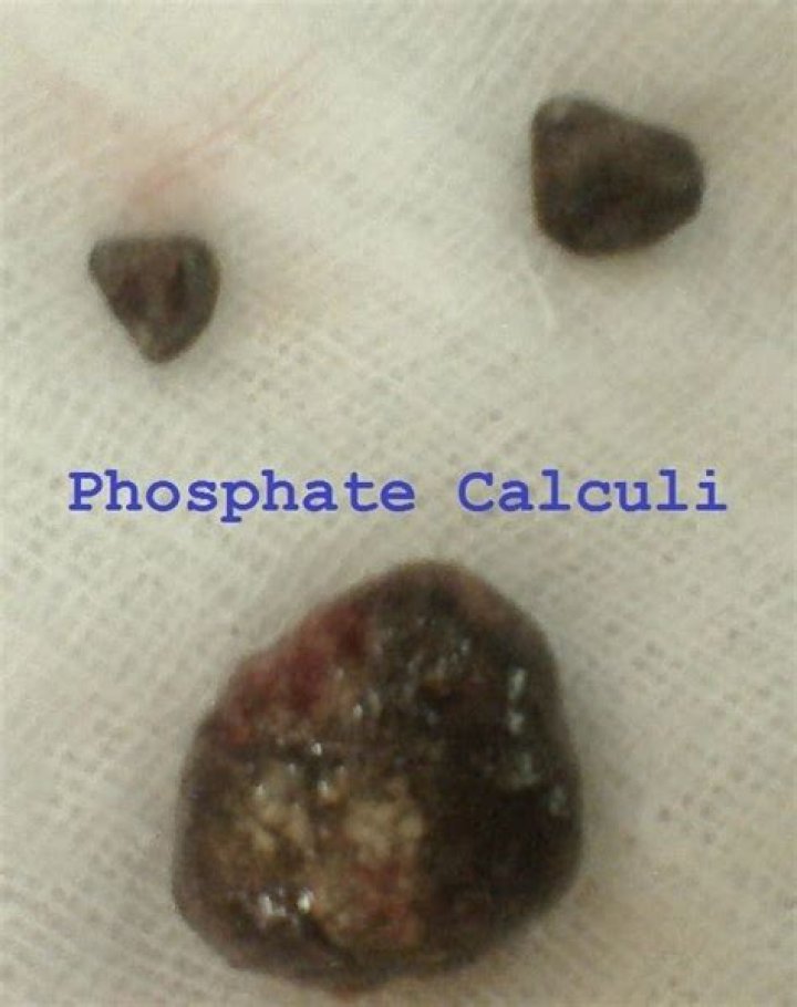 Can kidney stones be black?