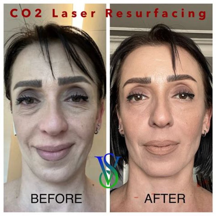 Can laser make skin worse?