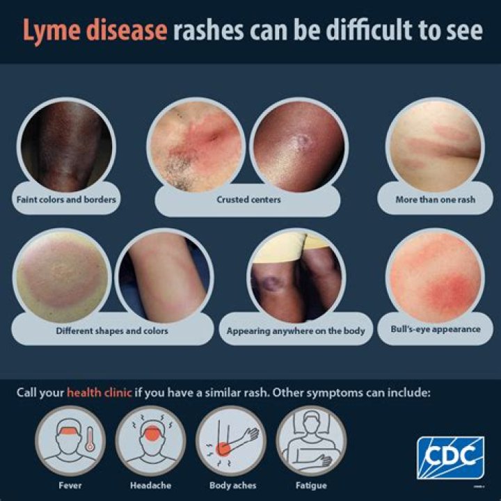 Can Lyme disease affect your personality?