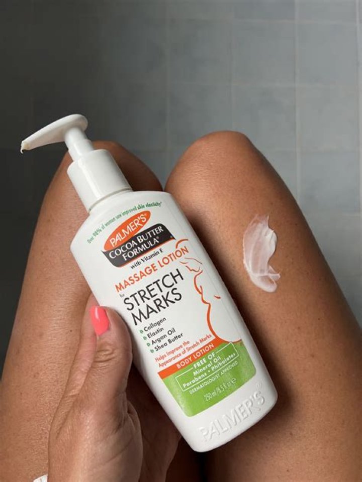 Can Nivea cream remove stretch marks?