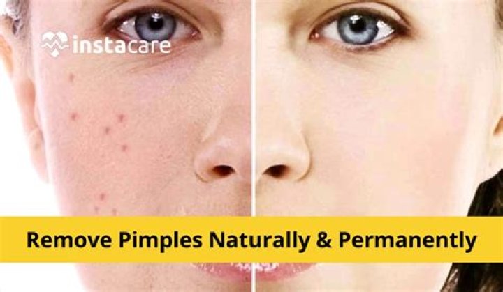 Can olive oil remove pimple marks?