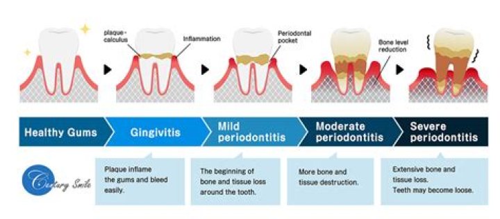 Can periodontitis be cured without surgery?