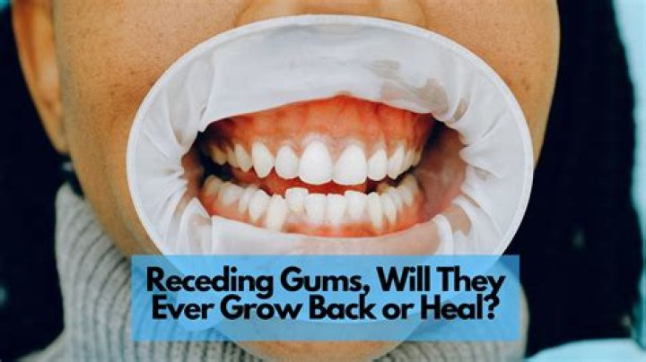 Can receding gums be reversed?