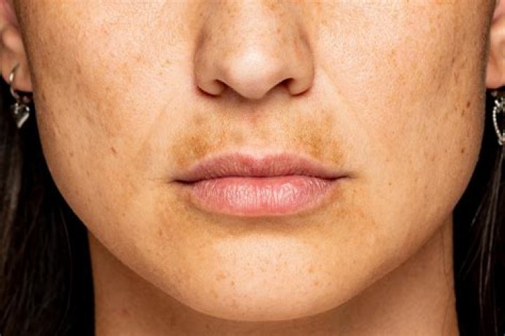 Can red LED light cause hyperpigmentation?