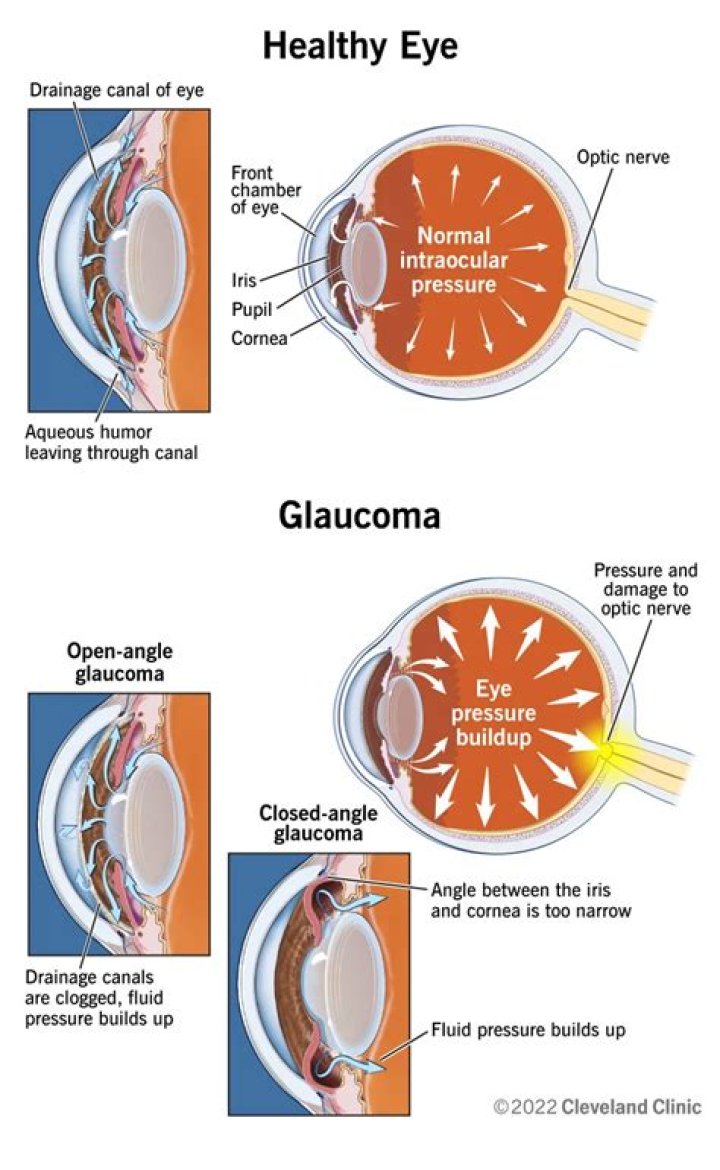 Can rubbing eyes cause glaucoma?