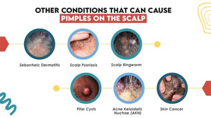 Can soap cause pimples?