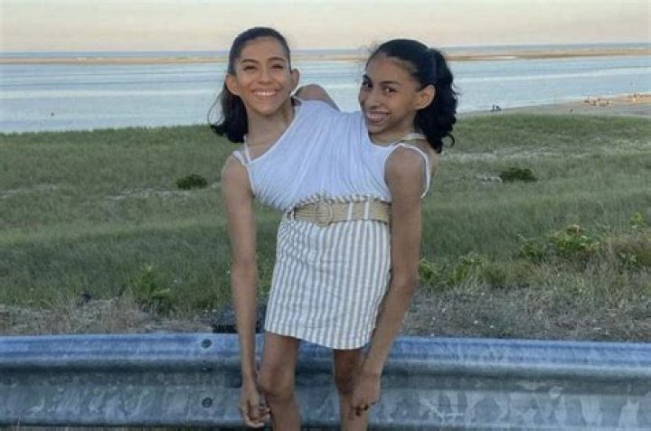 Can there be boy and girl conjoined twins?