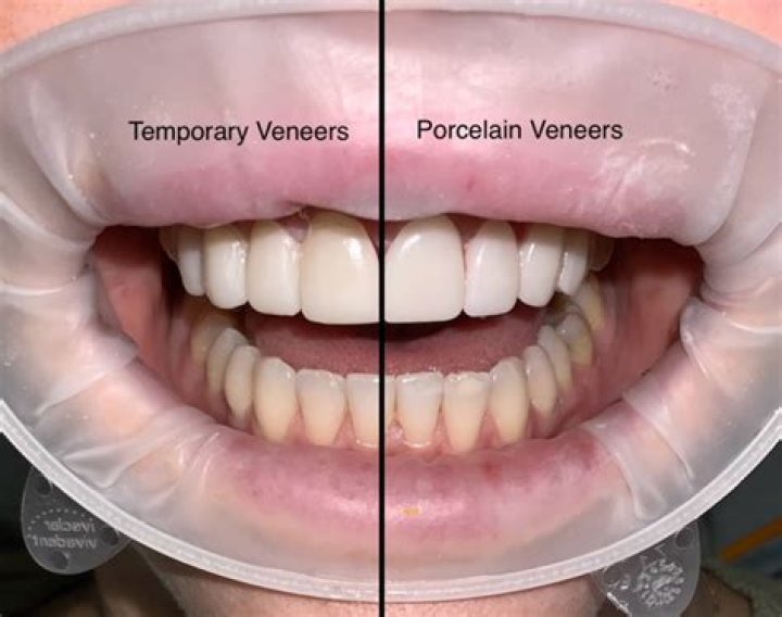 Can veneers be put on loose teeth?