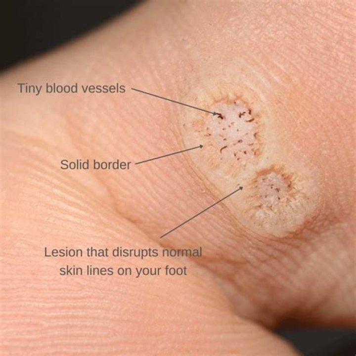Can warts on hands spread to other parts of the body?