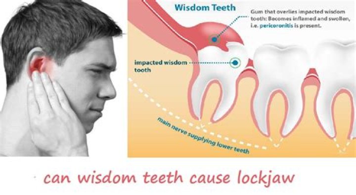 Can wisdom teeth cause jaw and ear pain?